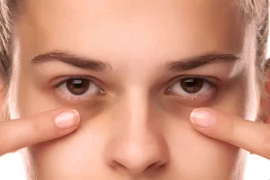 از بین بردن کبودی و سیاهی زیر و دور چشم برای همیشه | با این روش های خانگی از شر سیاهی دور چشم خلاص شو