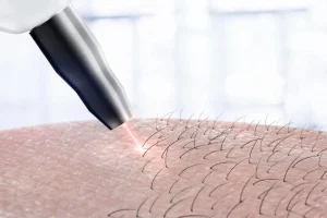 خطرات و عوارض لیزر موهای زائد که هیچکس به شما نخواهد گفت