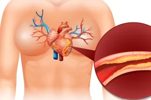 چربی اضافه را از خون خود پاک کن | چگونه چربی خون بالا را کنترل کنیم؟