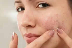 مهمونی دعوتی و جوش مجلسی زدی؟ بیا اینجا یه روش بگم سه سوته از شر جوشت خلاص شی