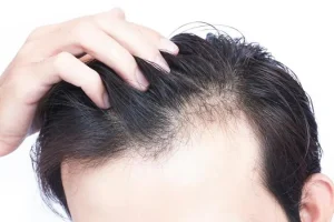 کلید درمان کامل طاسی و ریزش مو را بشناسید