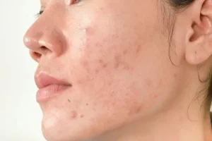 این جوش هارو جدی بگیرید اونا علاوه بر مزاحم بودن زنگ خطر بیماری اند