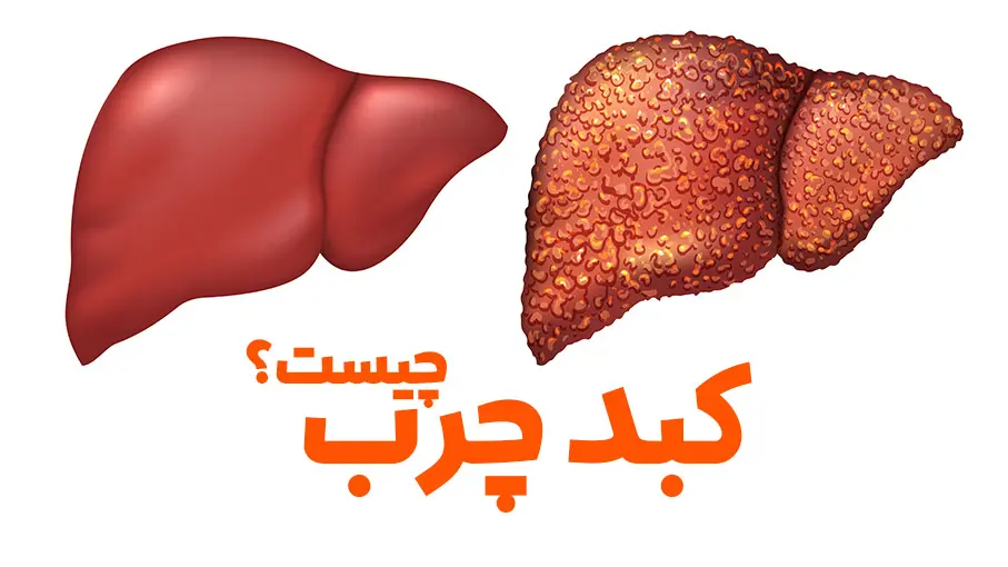 این گیاه ایرانی کبد شما را نجات می دهد