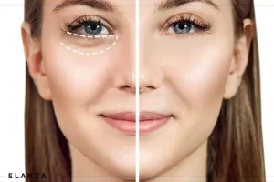 با این مواد خونگی پف زیر چشمتو بخوابون