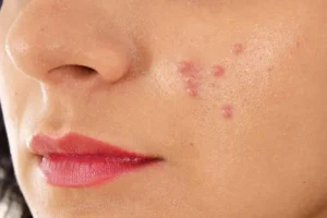واسه جوشای صورتت زیاد هزینه نکن | یک روش کاملا خانگی و بصرفه برای خلاص شدن از جوش صورت برای همیشه