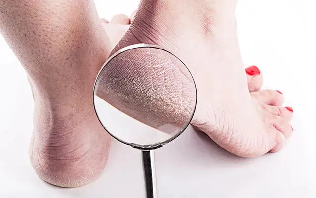 ۵ علامت هشدار دهنده از مشکلات خطرناک کبدی که در پاهایتان ظاهر میشود