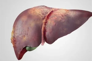 چند توصیه طلایی طب سنتی برای جلوگیری و درمان کبد چرب