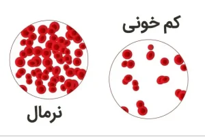 قاتل کمخونی شناسایی شد | این سبزی قاتل کم خونی و کمبود آهن