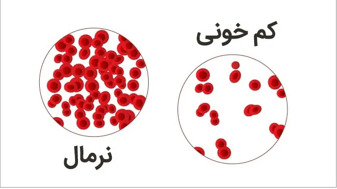 قاتل کمخونی شناسایی شد | این سبزی قاتل کم خونی و کمبود آهن