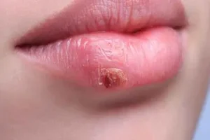 تبخال رو تو سیم ثانیه تار و مار کن | درمان خانگی و فوری تبخال