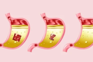 کاهش فوری و خانگی اسید معده بدون دارو