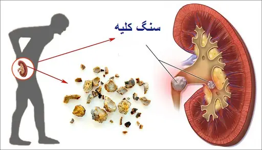 دفع سنگ کلیه در کمترین زمان با این نوشیدنی های ساده خانگی
