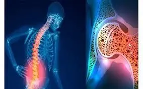 استخوانهای محکم و قوی می خواهید ؟ این ویتامین راه حل شماست
