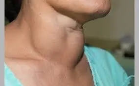 روشی طبیعی برای کسانی که کم کاری تیروئید دارند
