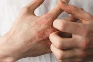 با این راهکارها از خشکی پوست جلوگیری کنید