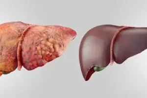 این نشانه ها علائم اولیه آسیب کبدیه | تا این نشانه هارو دیدی سریع برو دکتر