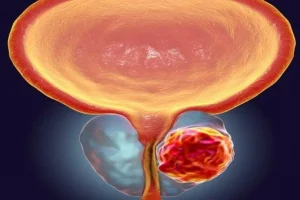 مهم‌ترین علائم بزرگ شدن پروستات | تکرر ، سوزش ادرار و احساس سریع برای تخلیه ادرار