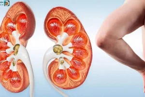 سنگ کلیه دارید ؟ این گیاهان مخصوص شماست