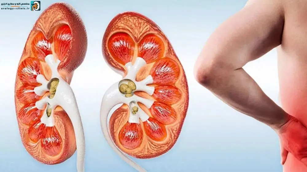 سنگ کلیه دارید ؟ این گیاهان مخصوص شماست