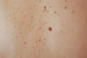 اگر خال بدنتان این رنگی است در معرض سرطان هستید