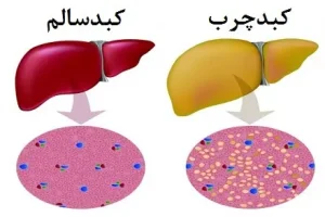 گیاهی برای غلبه بر کبد چرب