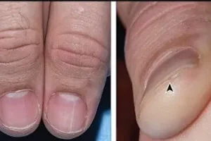 ناخن هات اینطوری تغییر شکل عجیب داد حتما برو دکتر | هر تغییر حتی کوچیکش تو شکل و ظاهر ناخون هشدار بیماری بزرگ میده