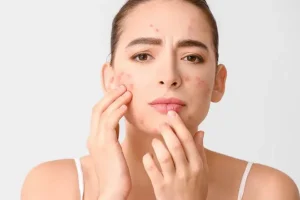 چند درمان خانگی برای رفع فوری جوشهای صورت