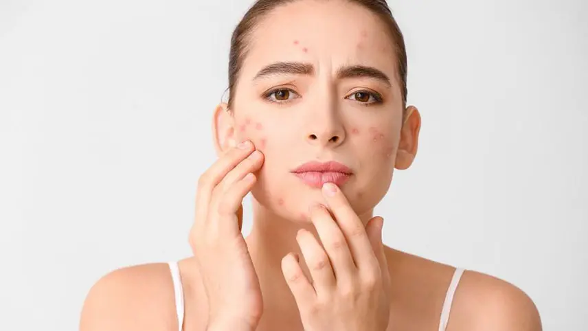 چند درمان خانگی برای رفع فوری جوشهای صورت