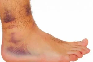 اگه یکی از نشونه هارو داری بدون که یک جای بدنت خون لخته شده