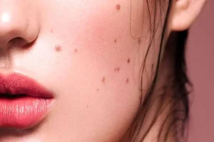 خال هر قسمت از بدن نشانه چیست؟ | بگو کجای بدنت خال داری تا چیزایی ازت بگم که تا حالا نمیدونستی