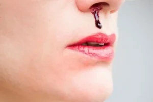 هشدار مهم برای کسانیکه اول صبح خون دماغ میشن / راه درمان