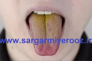 اگر زبانتان همیشه زرد هست بخوانید + راه درمان | زردی زبان نشانه کدام ن ایبیماری خطرناک است