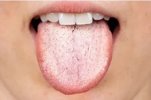 اگر زبان سفیدی دارید این خبر برای شماست