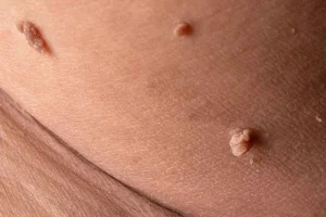 تفاوت خال گوشتی و زگیل | کندن زگیل با ناخنگیر یا بستن نخ خطرناک است؟