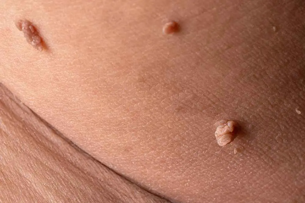 تفاوت خال گوشتی و زگیل | کندن زگیل با ناخنگیر یا بستن نخ خطرناک است؟