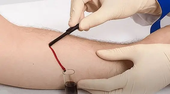 فصد خون چیست؟ فواید شگفتانگیز، عوارض احتمالی و بهترین زمان انجام آن