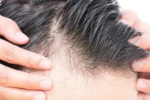 این نوشیدنی محبوب ریزش مو مردان را افزایش می دهد