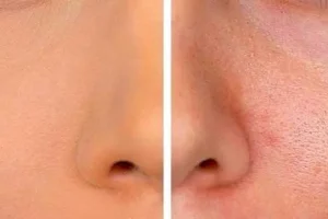 چگونه منافذ پوست را ببندیم؟ | راهکارهای خانگی و تخصصی برای بستن منافذ پوست