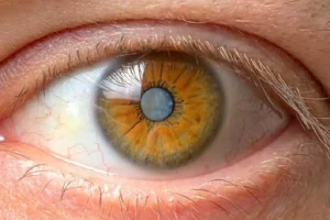 پیشگیری از آب مروارید با این راهکارهای ساده