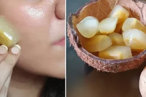 بوتاکس صورت با یخ سیب زمینی