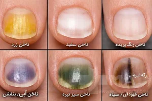 انواع بیماریهای ناخن و راه درمان آن