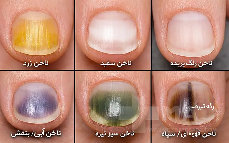 انواع بیماریهای ناخن و راه درمان آن