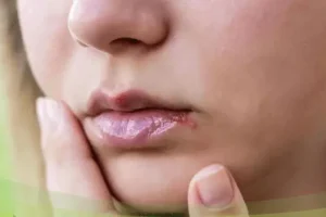 دانشمندان هشدار می‌دهند؛ ویروس تبخال عامل پنهان آلزایمر باشد!